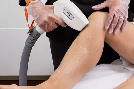 Laser Haarentfernung Köln